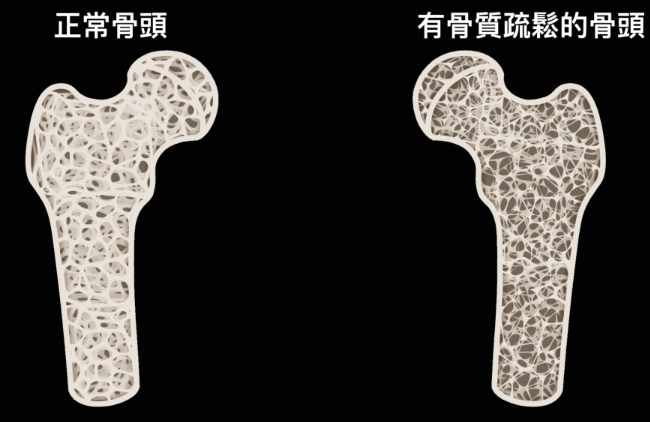骨質疏鬆預防 骨質疏鬆預防