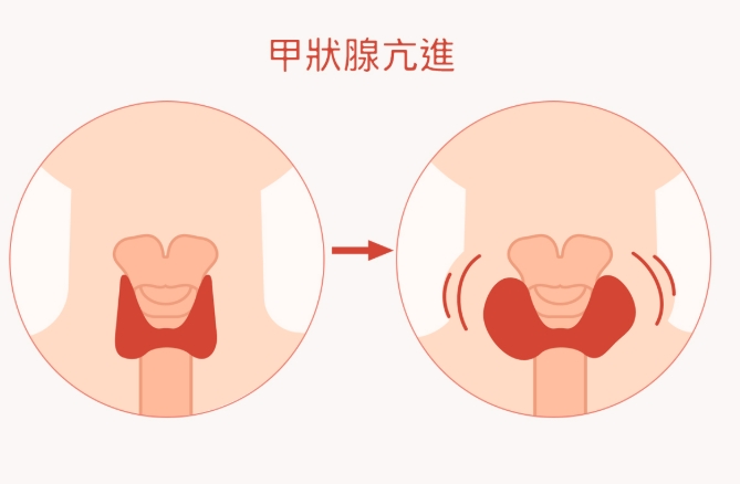 甲狀腺亢進飲食禁忌 甲狀腺亢進飲食禁忌