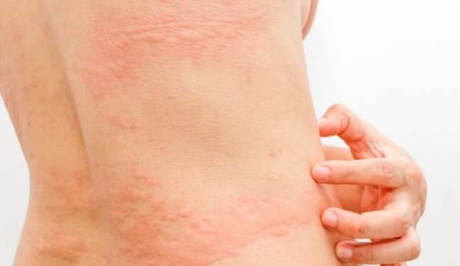 納豆副作用 納豆副作用