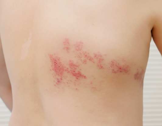 泡狀病毒防治 泡狀病毒防治