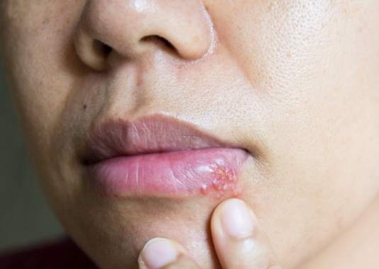 唇疱疹治療 唇疱疹治療