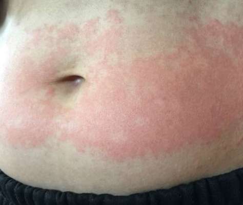 花粉副作用 花粉副作用