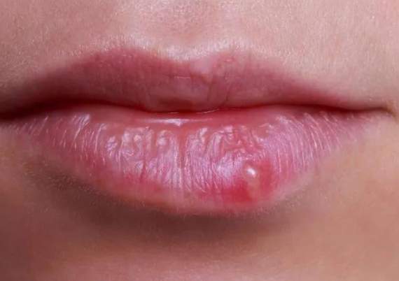 唇疱疹治療 唇疱疹治療