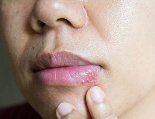 唇邊水泡治療 唇邊水泡治療