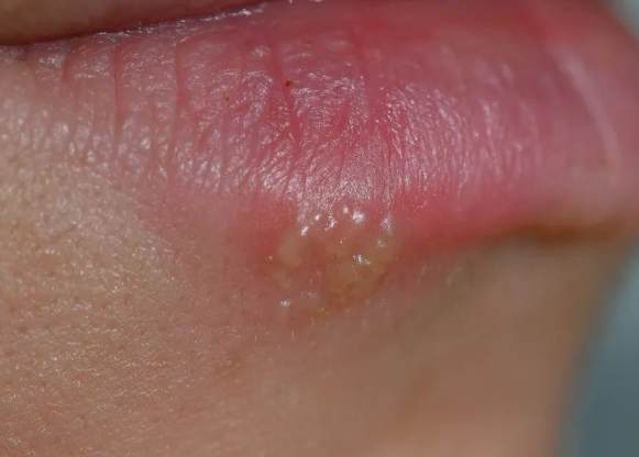 嘴唇水泡原因 嘴唇水泡原因