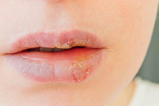 唇疱疹治療 唇疱疹治療