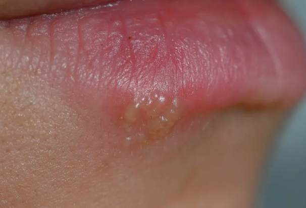 嘴唇水泡原因 嘴唇水泡原因