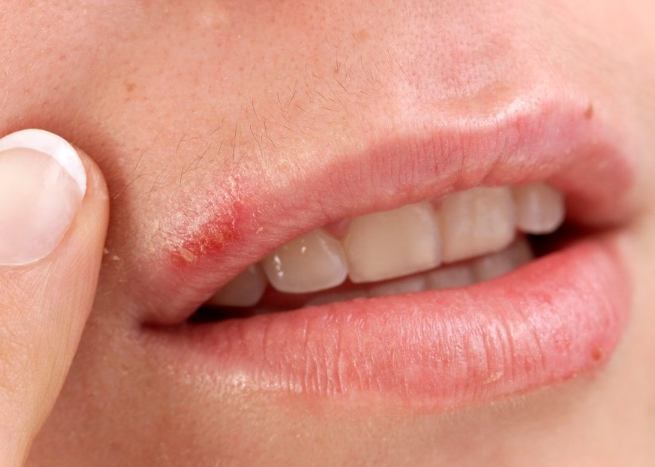 唇皰疹飲食指南 唇皰疹飲食指南