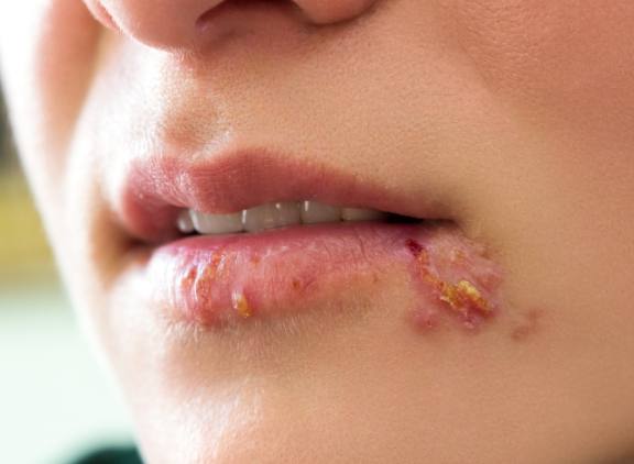唇邊水泡治療 唇邊水泡治療