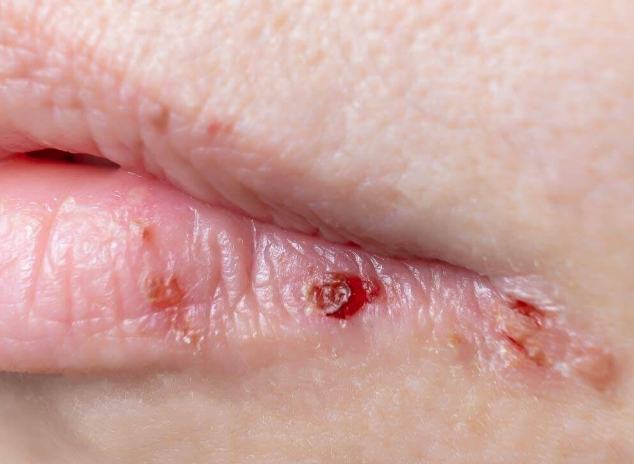 唇皰疹結痂護理