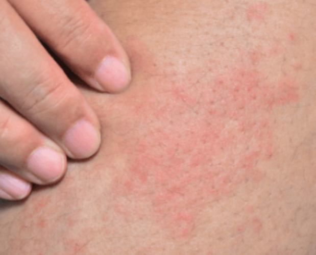 過敏不能吃的食物 過敏不能吃的食物