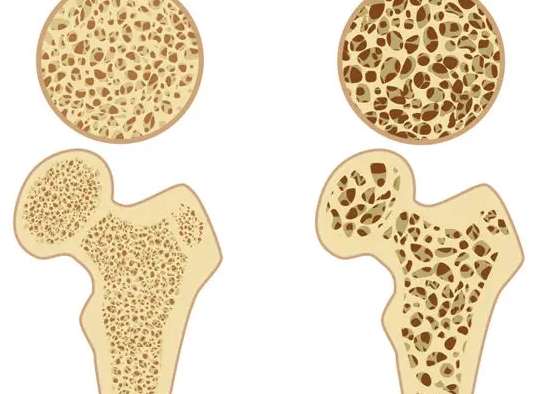 骨質疏鬆治療 骨質疏鬆治療