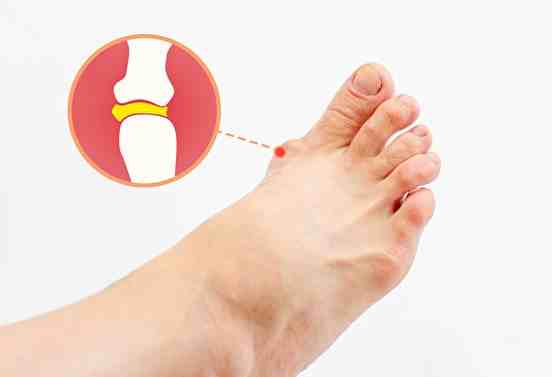 尿酸過高症狀 尿酸過高症狀