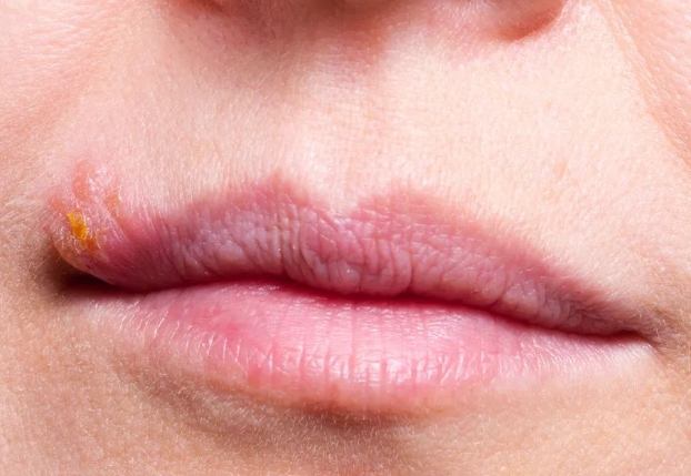 嘴唇水泡原因 嘴唇水泡原因