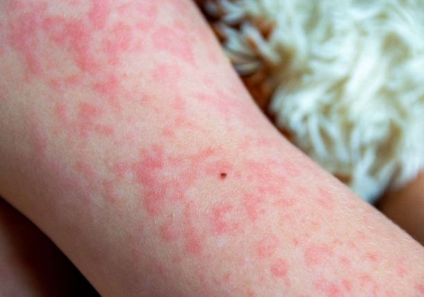 蕁麻疹飲食禁忌 蕁麻疹飲食禁忌