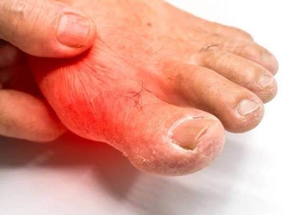 尿酸症狀 尿酸症狀