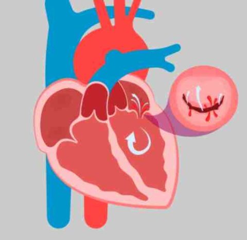 二尖瓣脫垂不能吃什麼