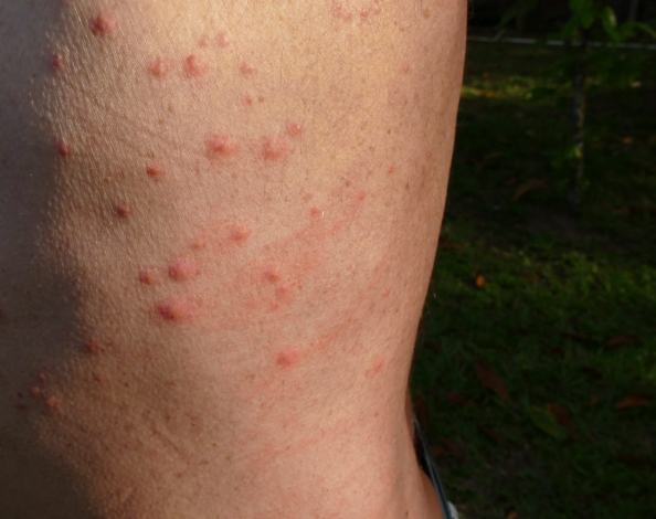 床蝨傷口處理 床蝨傷口處理