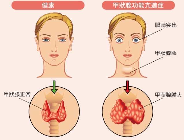 甲狀腺亢進 吃蛋 甲狀腺亢進 吃蛋