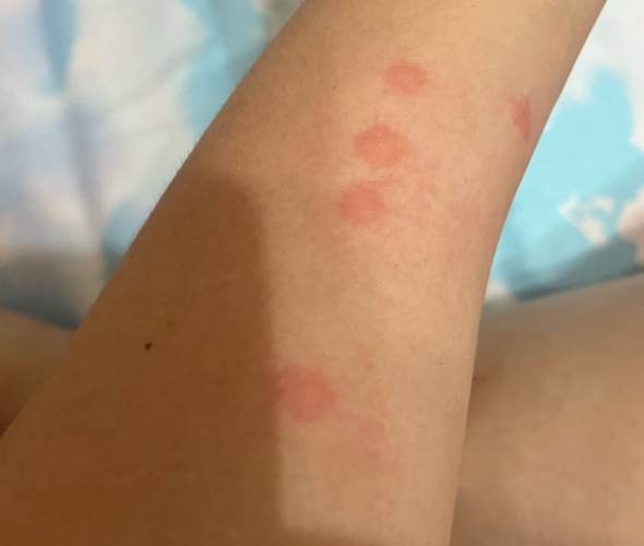 床蝨傷口處理 床蝨傷口處理