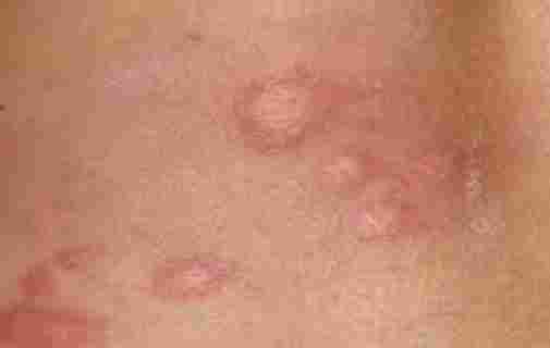 皮膚發炎治療 皮膚發炎治療