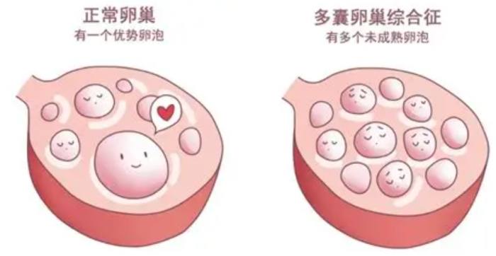 PCOS保健食品 PCOS保健食品