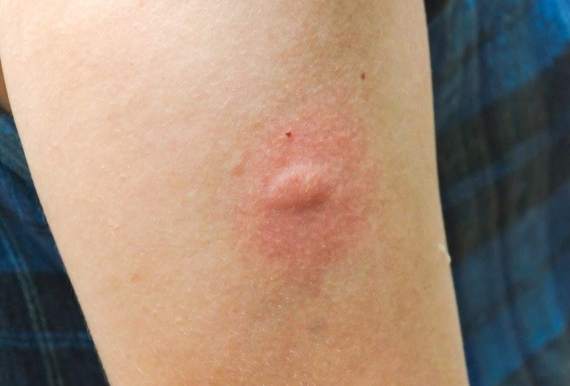 床虱咬傷症狀 床虱咬傷症狀