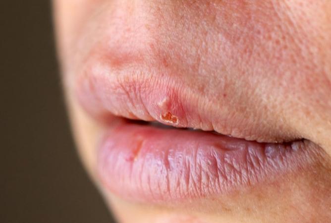嘴唇水泡原因 嘴唇水泡原因