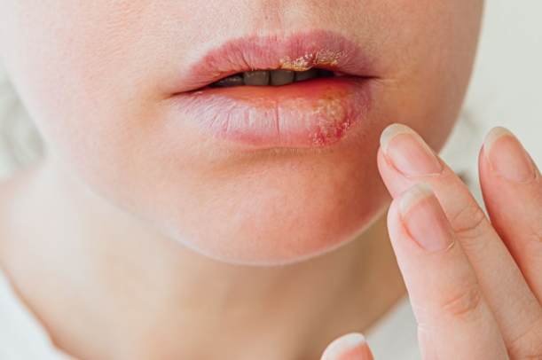 唇皰疹飲食禁忌 唇皰疹飲食禁忌
