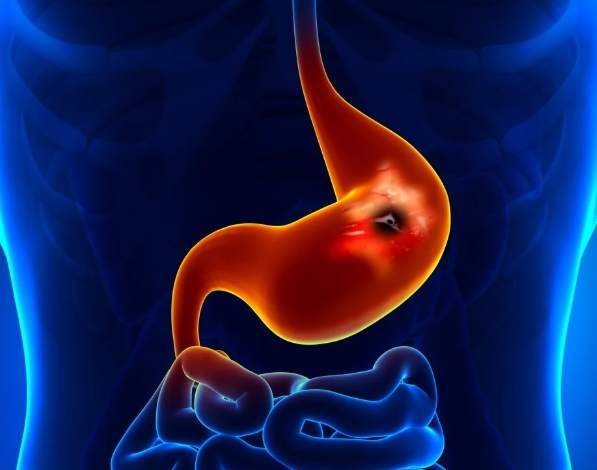 胃潰瘍可以吃紅蘿蔔嗎？專家解析飲食指南與實用建議