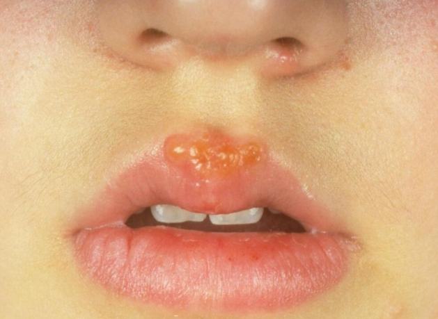 嘴唇水泡原因 嘴唇水泡原因