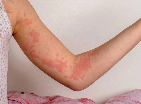 皮膚過敏飲食禁忌 皮膚過敏飲食禁忌