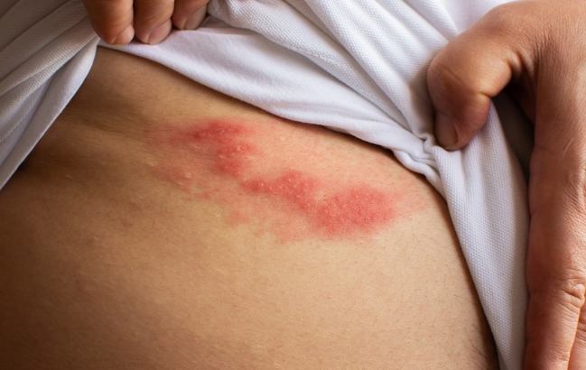 帶狀皰疹飲食 帶狀皰疹飲食