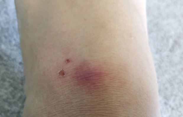 沙蠅傷口處理 沙蠅傷口處理