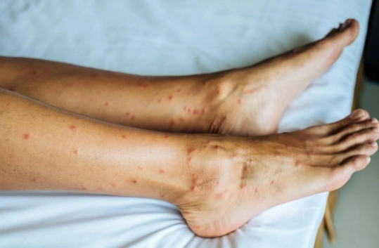 沙蠅咬傷預防 沙蠅咬傷預防