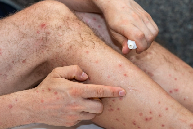 沙蠅叮咬症狀 沙蠅叮咬症狀