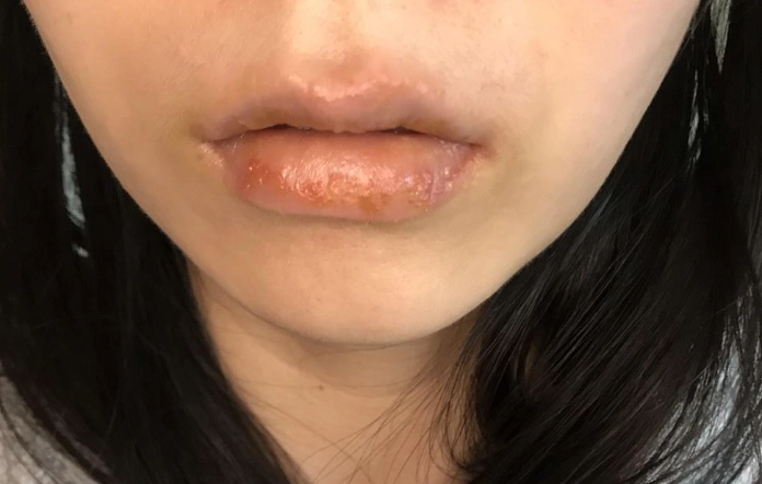 唇皰疹症狀