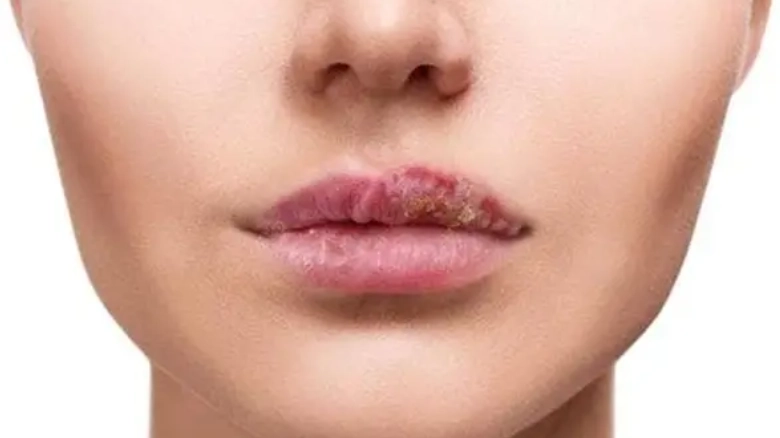 唇皰疹誘發因素 唇皰疹誘發因素