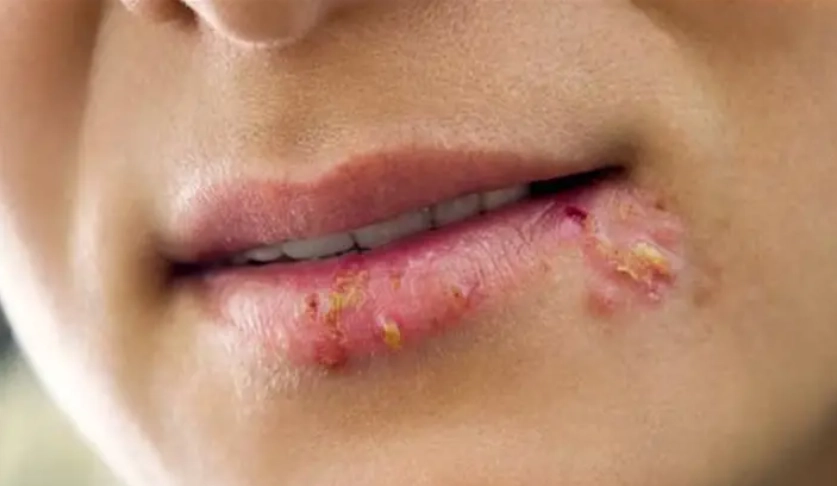 唇皰疹就醫科室
