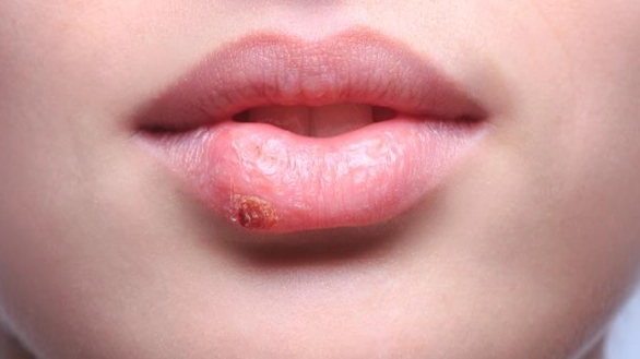 唇皰疹治療科別