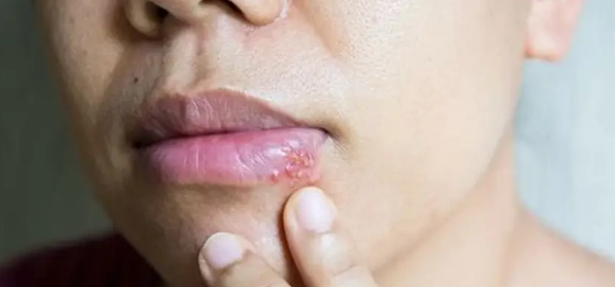 唇皰疹誘發因素 唇皰疹誘發因素