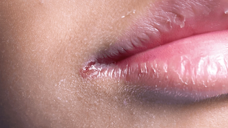 唇皰疹病毒 唇皰疹病毒