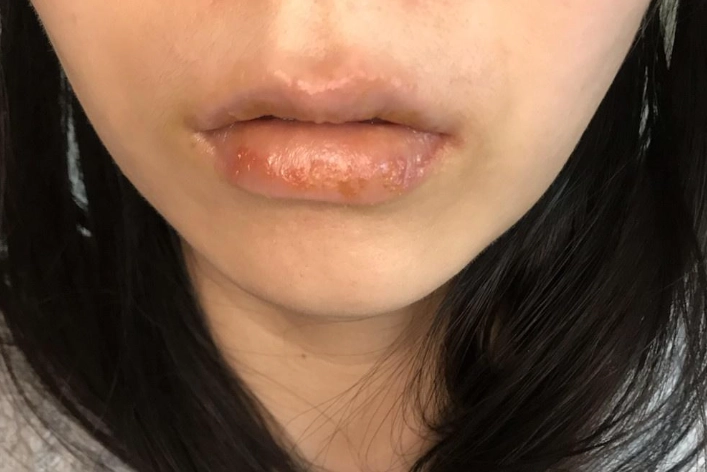 唇皰疹治療科別