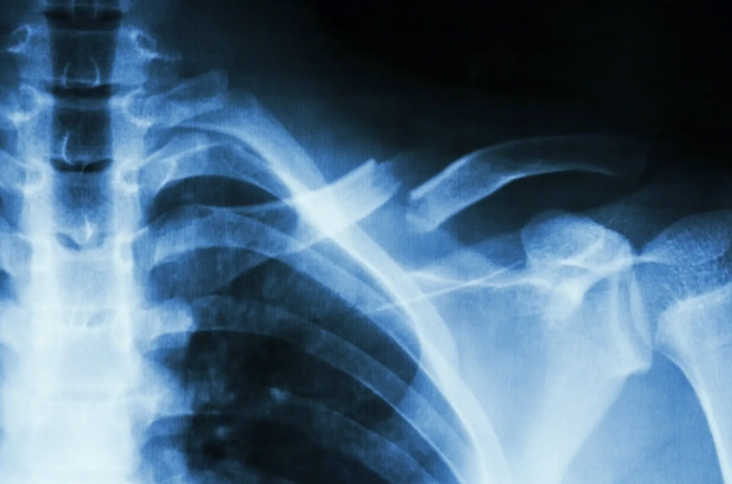 肋骨骨折飲食禁忌