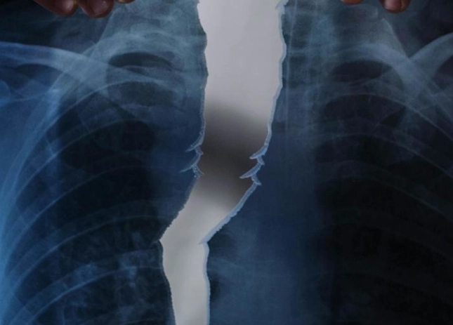 骨折後不能吃的食物