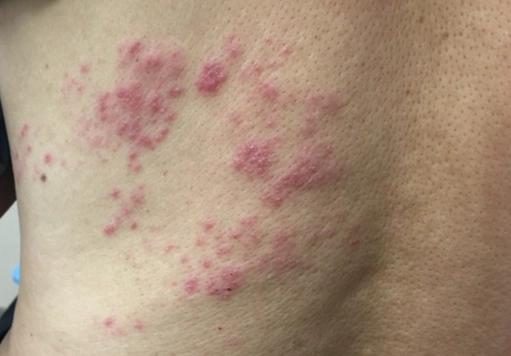 帶狀疱疹飲食 帶狀疱疹飲食