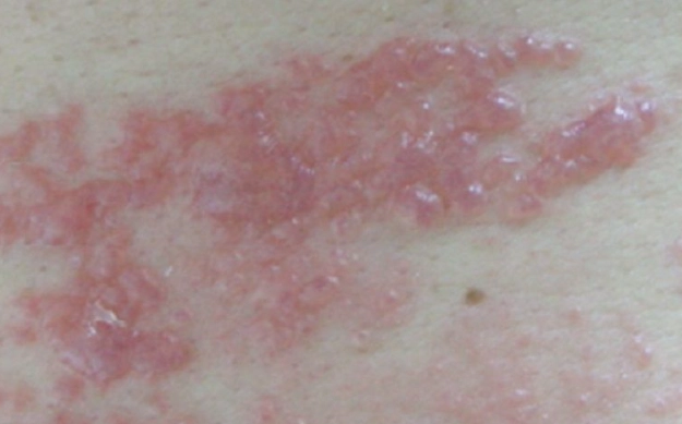 帶狀疱疹營養補充 帶狀疱疹營養補充