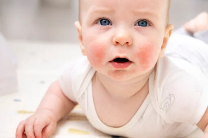 寶寶食物過敏紅疹多久會好