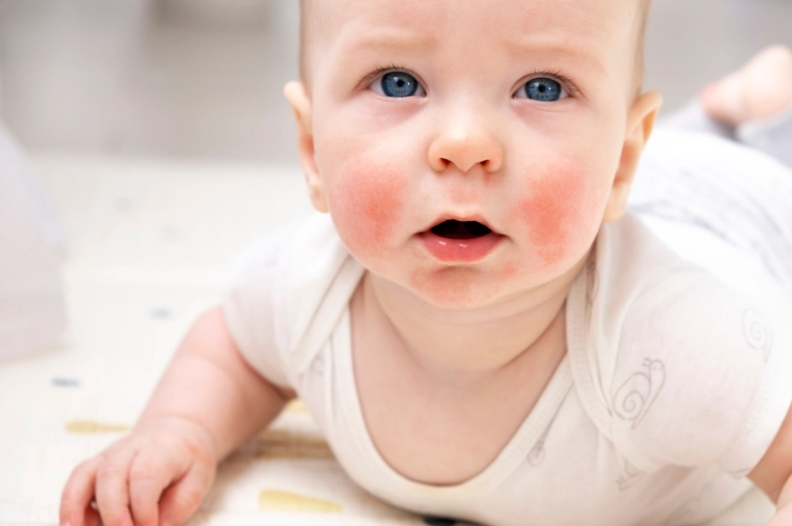 寶寶食物過敏紅疹多久會好？專業醫師解析恢復時間與照護指南