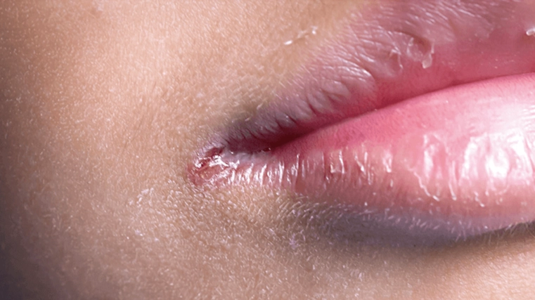 唇皰疹看什麼科